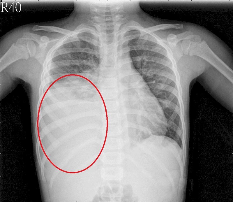 Symptoms Of Mycoplasma Pneumonia